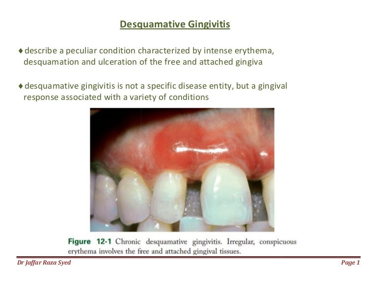 desquamative gingivitis